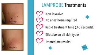 Lamprobe Noninvasive quick effective and painless [upl. by Sad430]