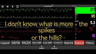 POV of a cardiologist vs a normal person on an ECG with ventricular ectopic beats [upl. by Tobin]