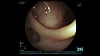 Colonic Diverticulosis [upl. by Ulises]