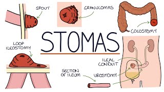 Understanding Stomas Colostomy Ileostomy Urostomy and Gastrostomy [upl. by Bonnell472]