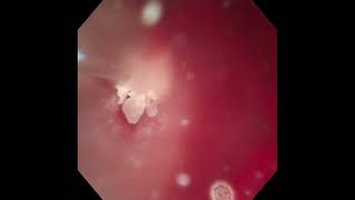 TFL LITHOTRIPSY IN A CAT WITH PSEUDOMEMBRANOUS CYSTITIS [upl. by Elleivad983]