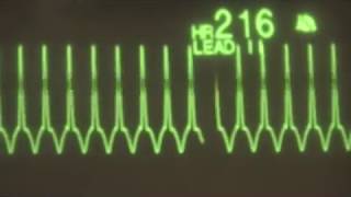 Supraventricular Tachycardia  ECG Training [upl. by Neille]