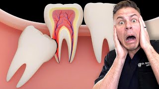 Is Removing Your Wisdom Teeth BAD For You [upl. by Sadye]