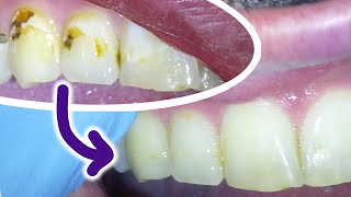 🦷 Fixing A Cavity On A Front Tooth With A White Filling Including Brown amp Black Decay Between Teeth [upl. by Pump]