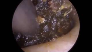 Blocked Ear Removal Extraction by Ear Wax Removal Specialist Mr Raithatha Ep 287 [upl. by Omoj]