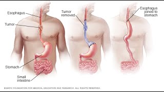 Treating Esophageal Cancer by Stage [upl. by Puff988]