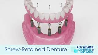 Demo How Do ImplantSecured Removable Dentures Work [upl. by Johan]