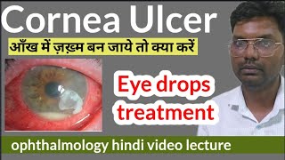 cornea ulcer treatment  cornea foreign body  corneal ulcer treatment  cornea ulcer eye drops [upl. by Jewel]