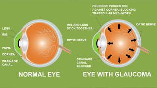 Eldercare Book Series Video 1 National Glaucoma Awareness Month [upl. by Havard]