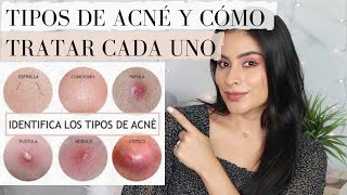 TIPOS DE ACNE Y COMO TRATARLOS [upl. by Kaczer]