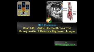 Ultrasound Case 145  Ankle Haemarthrosis amp EDL Tenosynovitis [upl. by Noroj]