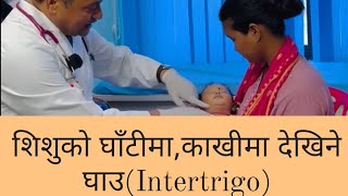 शिशुको घाँटीमाकाखीमा देखिने घाउIntertrigoDr Kishor Khatry swasthyapharmacy health healthtips [upl. by Kobylak]