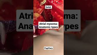 Atrial myxoma anatomic types [upl. by Belamy]