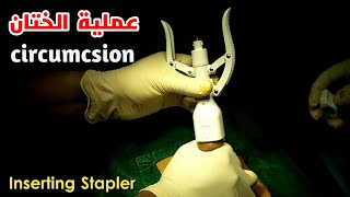 شاهد كيف تتم عملية ختان الذكورالطهارة Circumcision procedure [upl. by Anerdna]