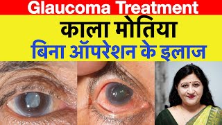 Kala Motia Ka Ilaj In Hindi  Glaucoma Eye Treatment  Acupressure Sujok Therapy For Glaucoma [upl. by Asante893]