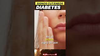 Signos Cutáneos y Síntomas Comunes de la Diabetes Tipo 2 [upl. by Acey]