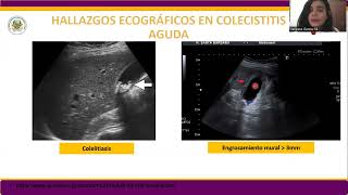 Colecistitis aguda en ecografía [upl. by Iridissa144]