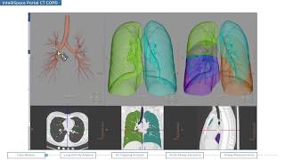 Philips IntelliSpace Portal clinical application CT COPD chronic obstructive pulmonary disease [upl. by Atillertse]