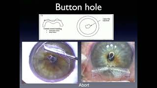 Refractive Course  04 LASIK FlapRelated Complications  Prof Yehia Salah [upl. by Acirederf853]