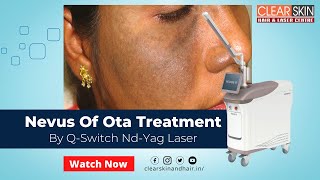 Nevus Of Ota Treatment by Q Switch Nd YAG Laser Helios  Nevus of OTA  Birth Mark  Laser Treatment [upl. by Etta]