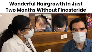 Wonderful Hairgrowth In Just Two Months Without Finasteride i Dr Suruchi Puri I [upl. by Carline518]