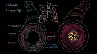 Asthme  Introduction  Physiopathologie  Triggers  Signes et symptomes [upl. by Eelrebmik]