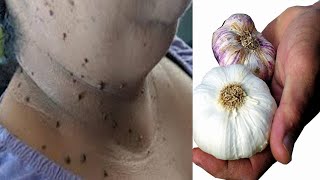 diy skin tag removal in 3 day  skin tag removal natural remedies with lemon remedy [upl. by Ailgna]