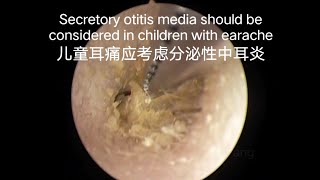 Children with earache should consider otitis media need to do earwax cleaning first儿童耳痛要考虑中耳炎要先清理耳垢 [upl. by Mack]