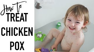 How to treat chicken pox  CHICKEN POX REMEDIES [upl. by Yrro]