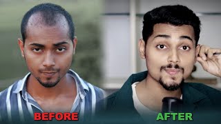 16 MONTHS RESULT AFTER HAIR TRANSPLANT  HAIR TRANSPLANT JOURNEY  HAIR TRANSPLANT [upl. by Renwick]