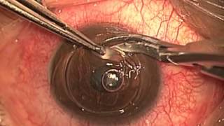 Trasplante de Cornea  Dr Abel Mauricio Martinez [upl. by Wileen]