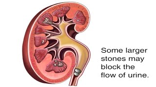 How Kidney Stones Are Formed Animation  Renal Calculi Causes amp Symptoms Video  Blocked Urine Flow [upl. by Sower]