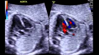 Tetralogy of Fallot 5 chamber view with colour [upl. by Goodwin95]