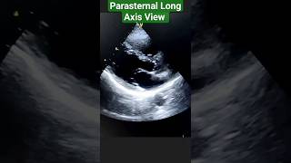 Parasternal long axis view shortvideo viralshorts trending doctor neet medicallover [upl. by Eniamraj421]