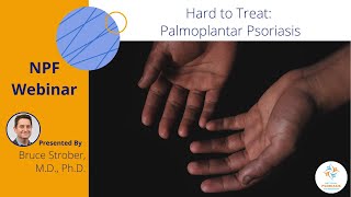 Hard to Treat Palmoplantar Psoriasis [upl. by Seka]