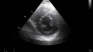 Left Atrial Myxoma  Echo [upl. by Pfister]