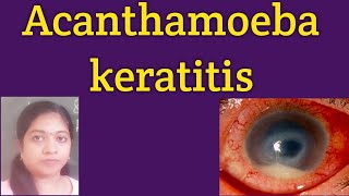 Acanthamoeba keratitis Life cycle of AcanthamoebaRadial perneuritisInvestigationsTreatment PHMB [upl. by Reinertson658]