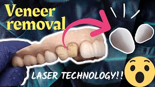 Dental Veneer amp Crown Removal using Laser Technology [upl. by Sanburn]