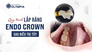 Trực Tiếp Lắp Endo Crown Phục Hình Răng Mất Tự Nhiên Như Thật Tối Ưu Chi Phí  Ths BS Phạm Hùng Sơn [upl. by Oballa]