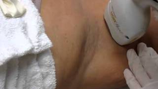 Laser Hair Reduction in Houston and Clear Lake Area [upl. by Ainessey]