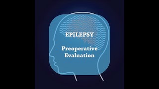 Neurosurgery Basics Lecture  Epilepsy  Preoperative evaluation [upl. by Akcimahs79]