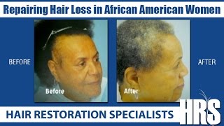 Repairing Hair Loss in African American Women  Hair Restoration Specialists of Atlanta [upl. by Getter358]