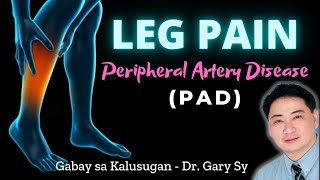 Leg Pain Peripheral Artery Disease PAD  Dr Gary Sy [upl. by Germano126]