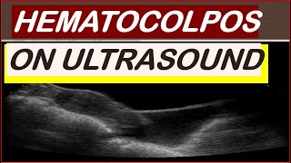 Hematocolpos on ultrasound [upl. by Anahcar]