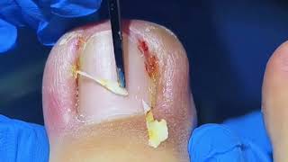 Satisfying Ingrown Toenail Removal [upl. by Butterworth186]