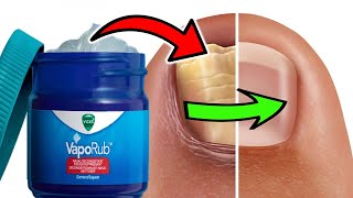 HOW TO USE VICKS VAPORUB TO TREAT TOENAIL FUNGUS [upl. by Nedrud]