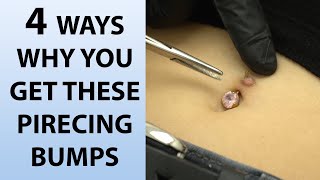 4 Reasons Why You Get Piercing Bumps [upl. by Trudi393]