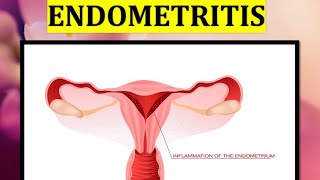 ENDOMETRITIS Acute chronic Atrophic Causes  Clinical features Diagnosis andTreatment [upl. by Zacharia360]