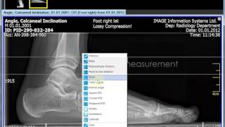 Orthopedic Measurements using iQVIEW 28 Calcaneus Inclination Angle [upl. by O'Conner319]