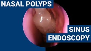 Nasal polyps  PHACON Sinus Patient Meyer [upl. by Marilyn]